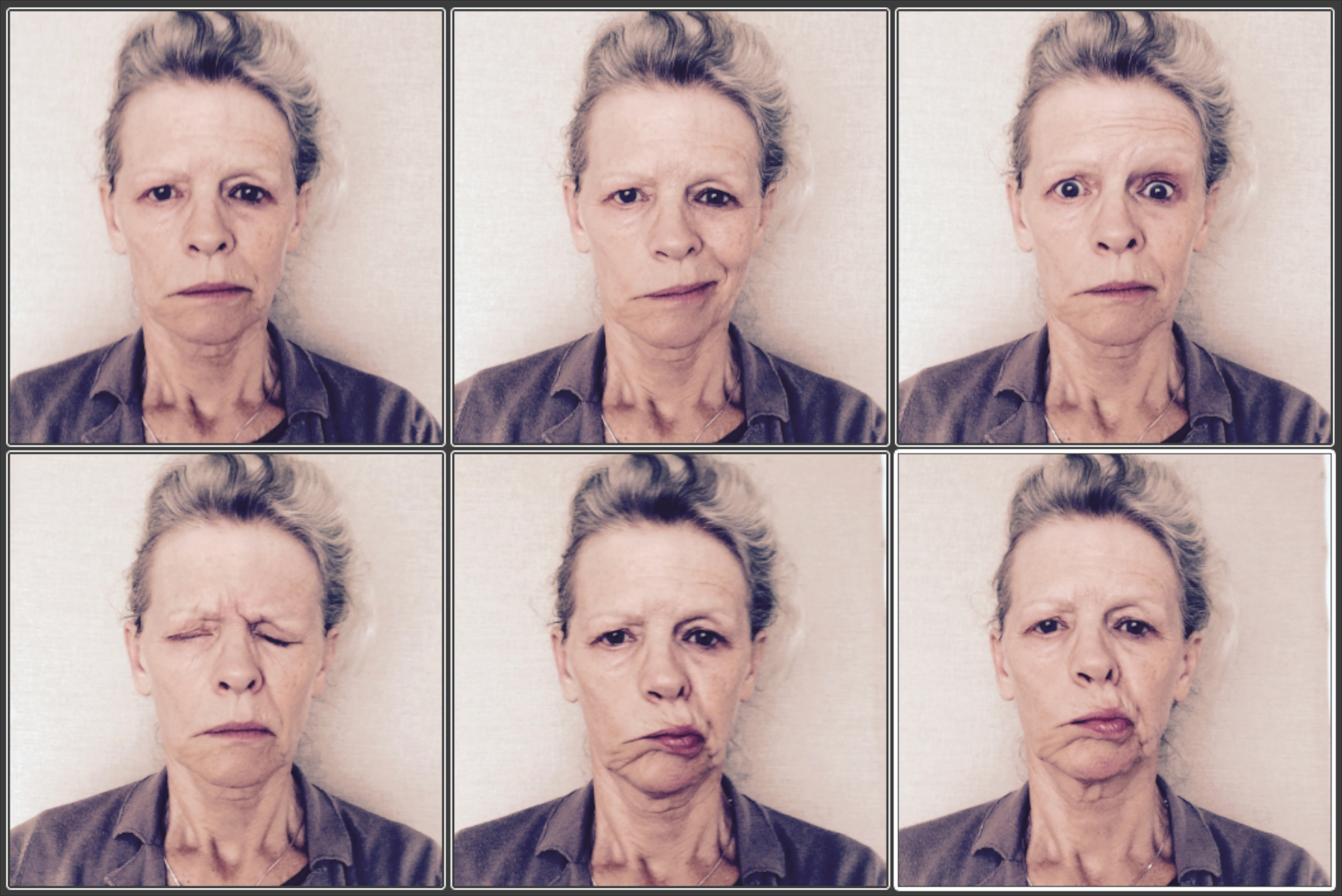 Six pictures of a woman with facial paralysis making different expressions